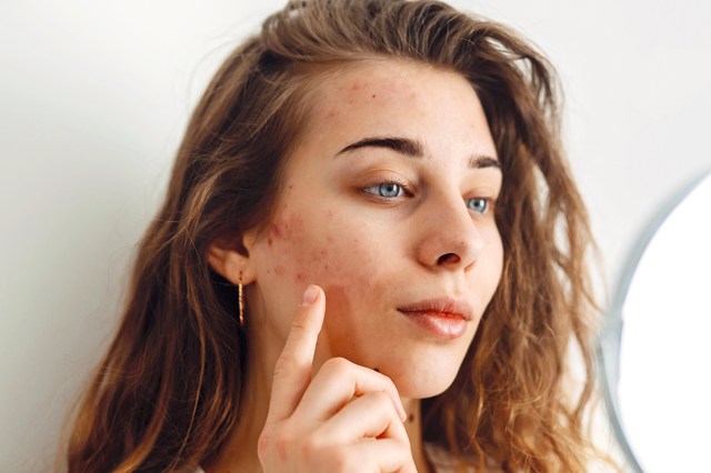 woman with acne