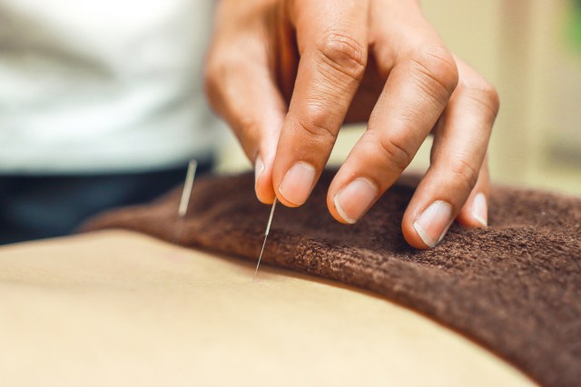 acupuncture needles going into a back 