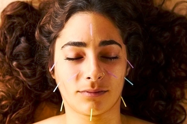 brunette woman with acupuncture needles in her face