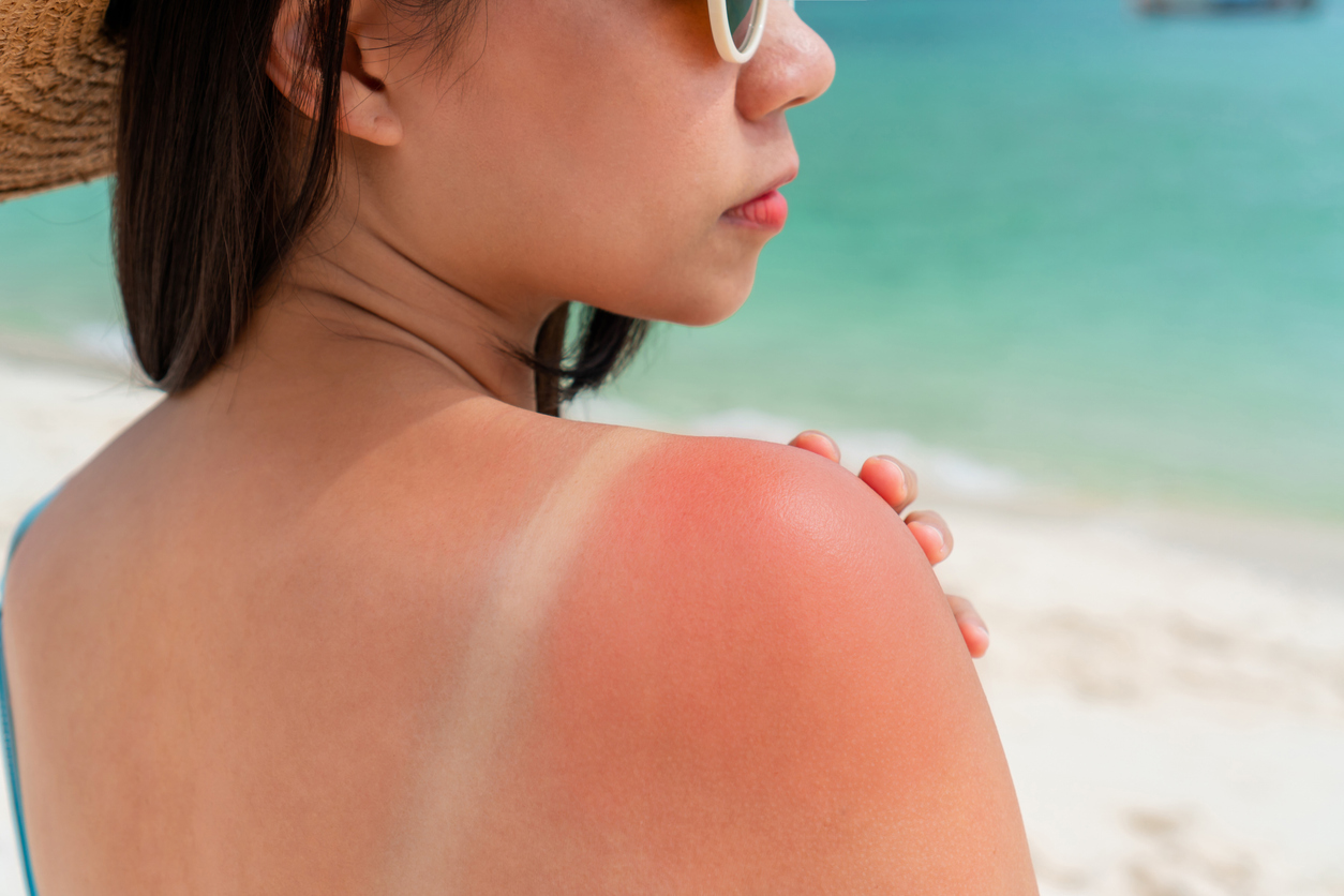 woman at beach showing the sunburn on shoulder