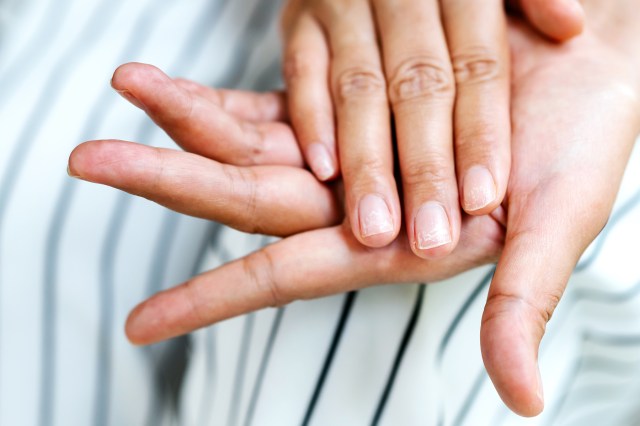 Close up of a woman's hand with brittle nails