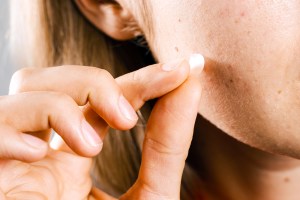 Woman using acne patches for treatment of pimple and rosacea close-up