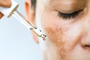 Close up of woman with hyperpigmentation on her face